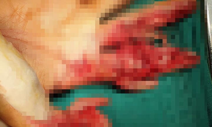 Người phụ nữ 48 tuổi bị máy xay thịt nghiền nát bàn tay