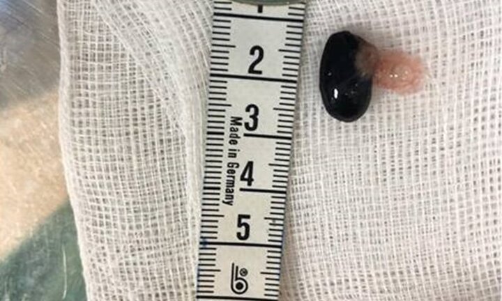 Hóc hạt mãng cầu, bé trai ngừng tim, ngừng thở suýt chết