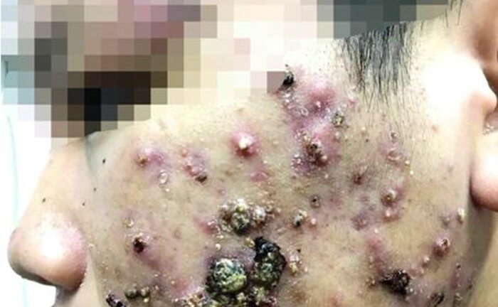 Dùng mỹ phẩm không rõ nguồn gốc, nhiều nữ sinh bị 'nát mặt'