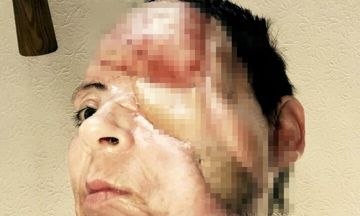 Bị pháo hoa bắn thẳng vào mặt, người phụ nữ suýt chết