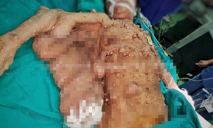Phẫu thuật cứu người phụ nữ có hàng trăm khối u xõa như cánh đại bàng