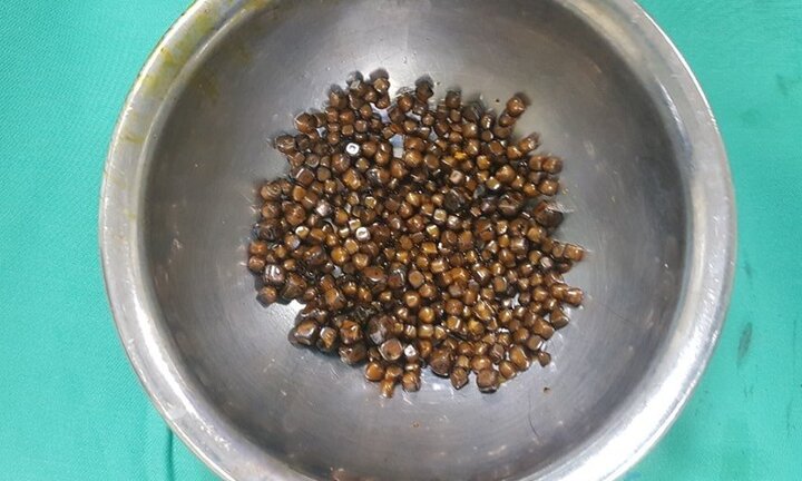 Hoảng hồn bác sĩ gắp gần 400 viên sỏi trong túi mật người phụ nữ 60 tuổi