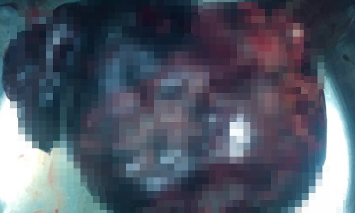 Cụ bà 89 tuổi nặng vỏn vẹn 28 kg có khối u buồng trứng khổng lồ