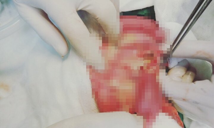 Cứu bé 36 tháng tuổi thủng ruột nguy kịch