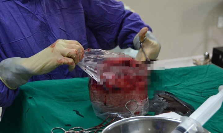 Người phụ nữ có khối u xơ tử cung to như bầu 5 tháng