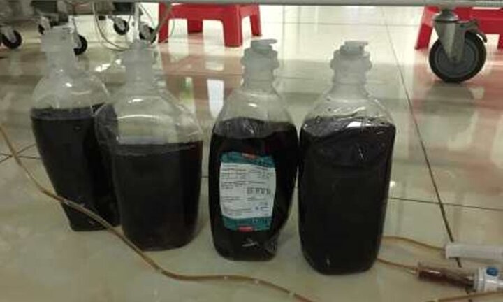 Uống hơn nửa lít rượu mỗi ngày, nam thanh niên viêm tụy cấp hoại tử, máu có màu đen đặc