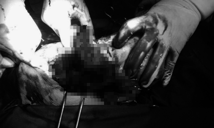 Sinh nở tại nhà, sản phụ vỡ tử cung, con chết lưu trong bụng mẹ