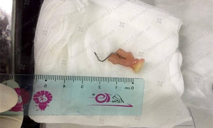 Sau cơn ho, răng giả chui ‘tọt’ vào cổ họng người đàn ông 35 tuổi