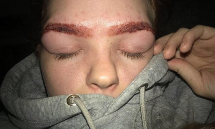 Nhuộm lông mày tại nhà, thiếu nữ 19 tuổi bị bỏng nặng