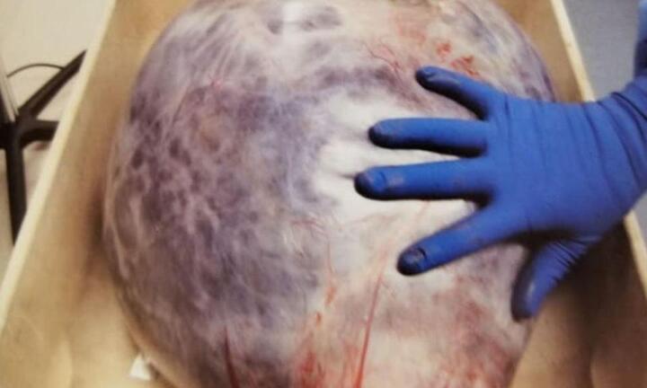 Nuôi khối u nặng hơn 22kg, người phụ nữ vẫn nghĩ mình ‘béo tự nhiên’