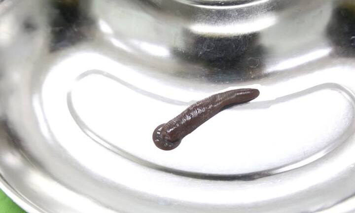 Đỉa trâu to bằng ngón tay cái ngoe nguẩy trong khí quản người đàn ông