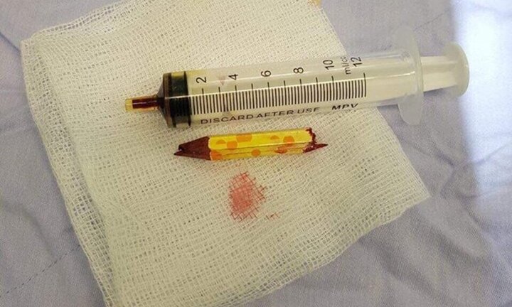 Hai trẻ nghịch dại dẫn đến tai nạn đáng tiếc, nhập viện cấp cứu trong đêm