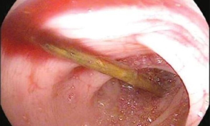 Tăm dài 5cm đâm thủng thành ruột của thanh niên 18 tuổi