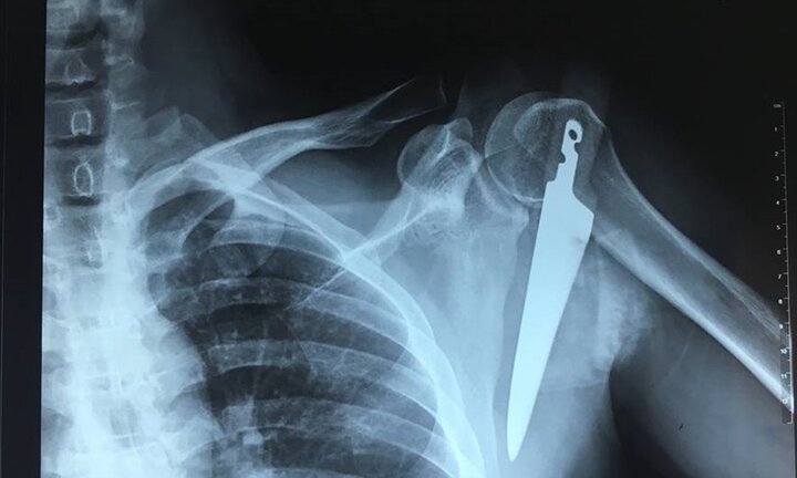 Người đàn ông bị dao dài 20cm đâm vào vai do vô tình vấp ngã trong bếp