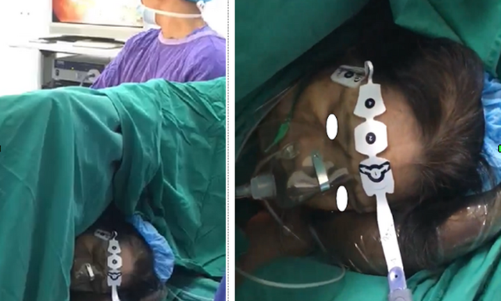 Lần đầu tiên Việt Nam cắt phổi không cần máy hỗ trợ thở