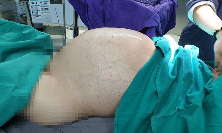 Phẫu thuật lấy khối u 25kg từ bụng nam thanh niên 26 tuổi