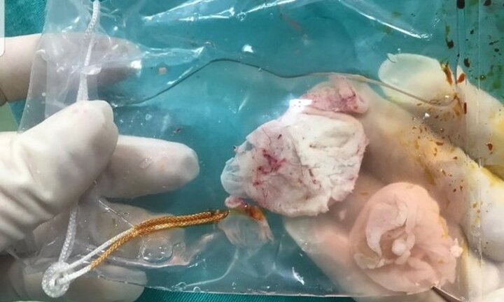 Ổ sán khổng lồ cư trú trong não người đàn ông có thói quen ăn tiết canh