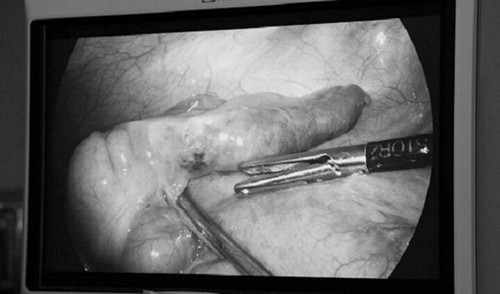 Đang phẫu thuật ruột thừa, bác sĩ 'hoảng hồn' khi thấy mảnh xương cá xuyên thủng ruột nam thanh niên