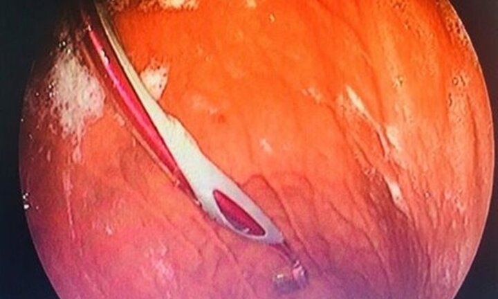 Lấy bàn chải chữa hóc xương cá, vô tình nuốt luôn cả bàn chải