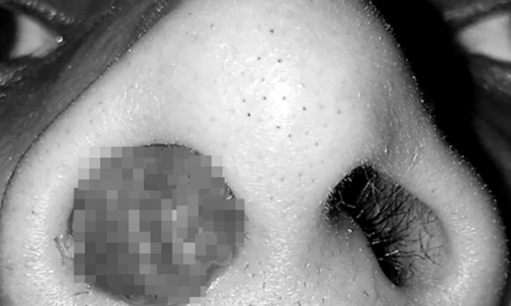 Chảy máu cam liên tục trong ba tháng do ký sinh trùng làm tổ trong mũi