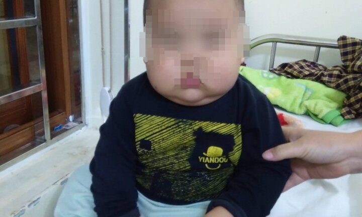 Gia đình tự mua thuốc điều trị tại nhà, bé trai suy thượng thận, phù mặt