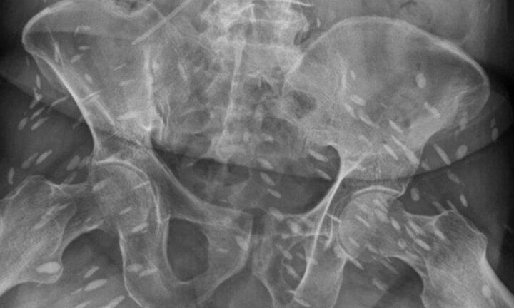 Sán làm tổ chi chít trong cơ thể người đàn ông 74 tuổi