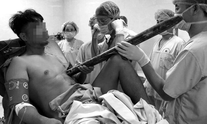 Chạy đua với thời gian cứu sống nam thanh niên bị ống sắt đâm thấu ngực