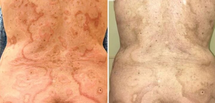 Cơ thể phát ban bất thường, coi chừng mắc bệnh ung thư