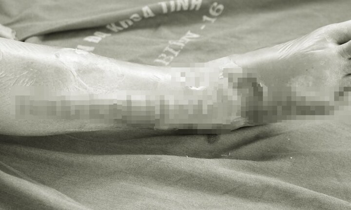 Tự chữa ngứa tại nhà theo 'đơn thuốc' của thầy lang, chân người phụ nữ bị hoại tử nặng