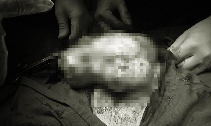 Phẫu thuật cắt khối u buồng trứng 4kg cho cụ bà 90 tuổi