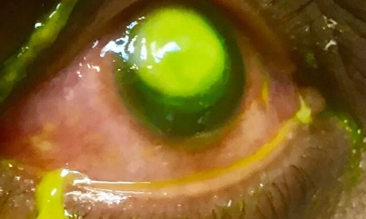 Đeo kính áp tròng ngủ qua đêm, người phụ nữ bị vi khuẩn ăn mòn giác mạc