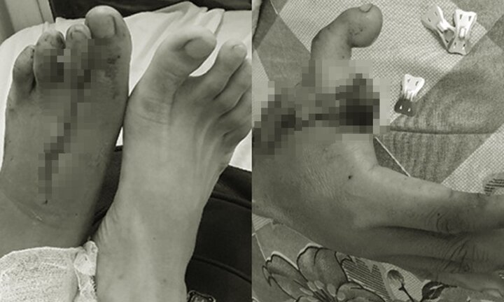 Cắt ngón chân ghép thành ngón tay cái cho nam thanh niên