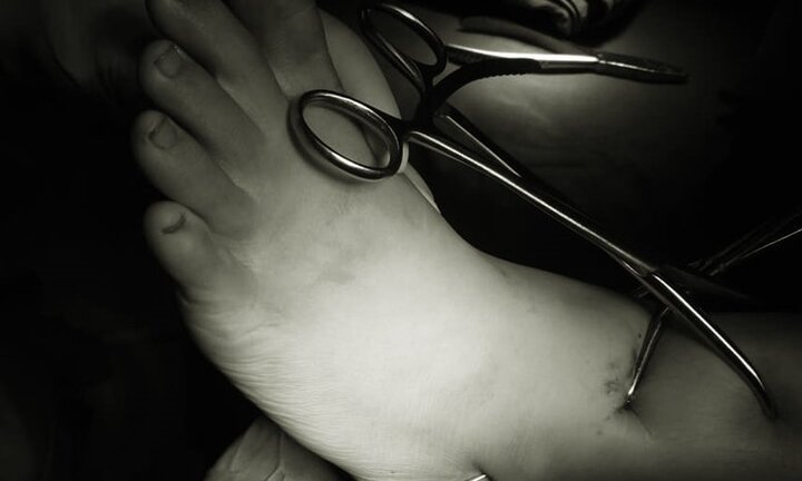 Không cần mổ hay bó bột, bé trai 14 tuổi gãy 2 xương vẫn được chữa khỏi