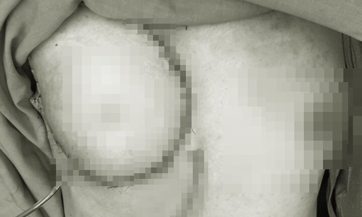 Bác sĩ dùng da phần bụng để tái tạo ngực cho bệnh nhân