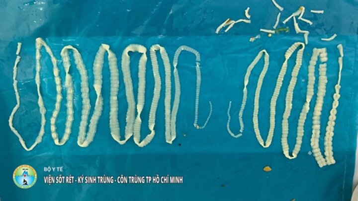 Hai con sán dây dài 4m hiếm gặp trong bụng người đàn ông