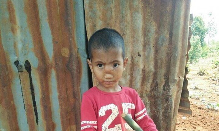 Bé trai người Gia Lai mắc bệnh não tụt xuống mũi được 'tái sinh' sự sống