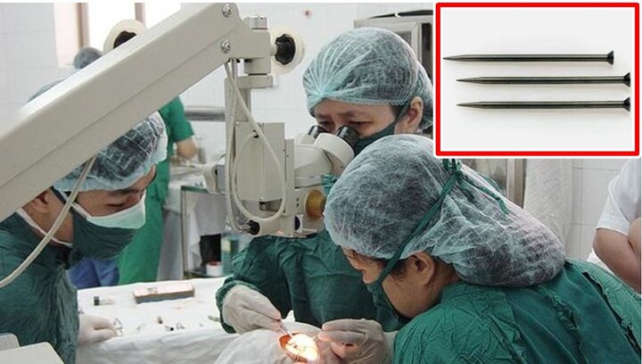 3 người đàn ông liều lĩnh tự cho tay rút đinh ra khỏi mắt