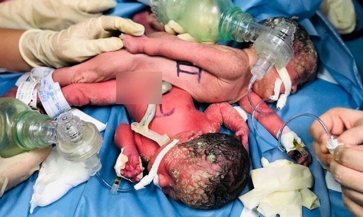 Cặp song sinh ở TP.HCM sinh ra đã dính liền nhau, có chung hậu môn