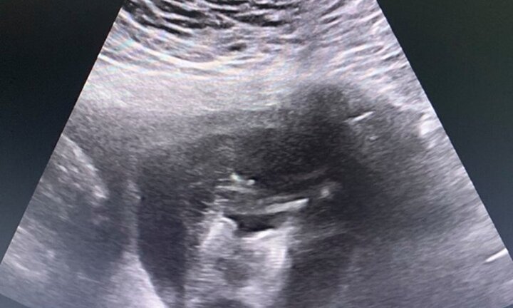 Cô gái trẻ ở Tuyên Quang mang song thai dính liền, chung một quả tim