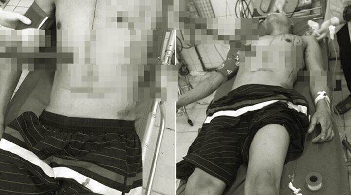 Trèo cây ngã, người đàn ông bị cây gỗ đâm xuyên bụng