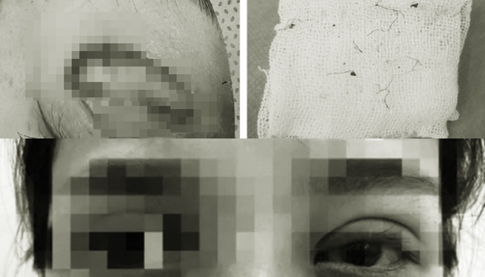 Nhấn mí làm đẹp tại spa gần nhà, cô gái trẻ loét cả giác mạc, suýt mù