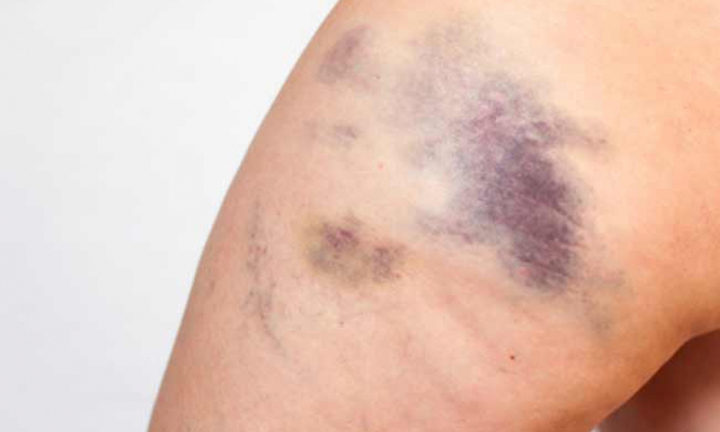 Những nguyên nhân phổ biến gây các vết bầm tím trên cơ thể