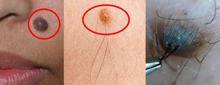 Nốt ruồi ở vị trí nào cảnh báo bệnh ung thư?