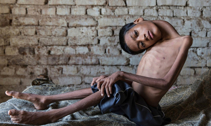 Cậu bé 'đầu không thể dựng thẳng', nhìn thế giới lộn ngược suốt 13 năm