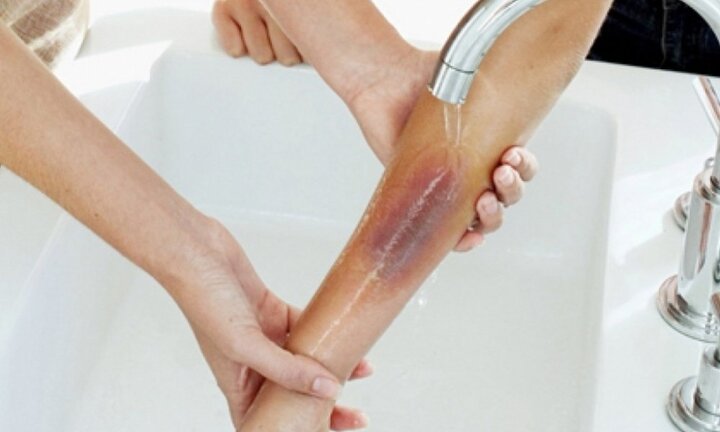 Những việc tuyệt đối không nên làm khi bị bỏng