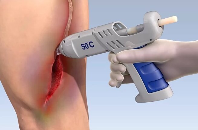 Súng bắn keo sinh học chữa lành vết thương