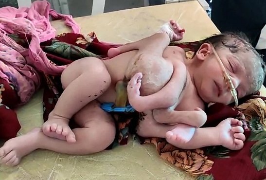 Bé gái chào đời với 3 tay, 4 chân