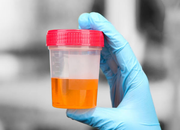 Những dấu hiệu cảnh báo ung thư tuyến tiền liệt