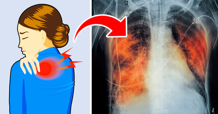 5 dấu hiệu của bệnh ung thư phổi nhiều người thường bỏ qua