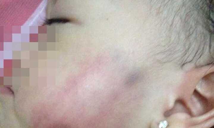 Nghi vấn bé gái 16 tháng tuổi bị tát bầm má: Thông tin mới nhất